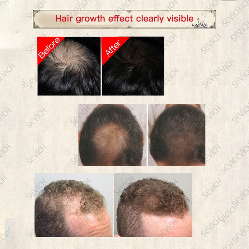 Hair Care Hair Growth Essential Oils Origin Authentic 100% Hair Loss Liquid Health Care Beauty Dense Hair Growth Serum Tools